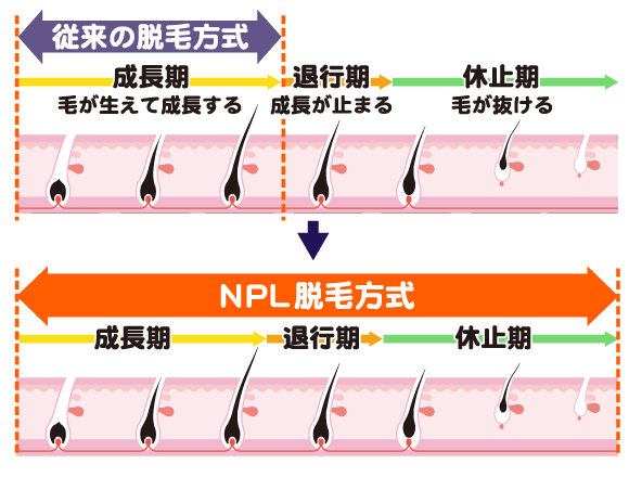 NPL方式は従来の脱毛方式よりも効果が長く続きます。